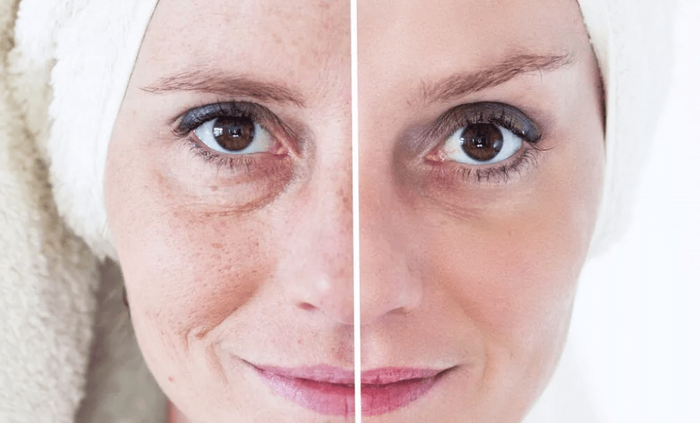 تجديد الوجه بالليزر